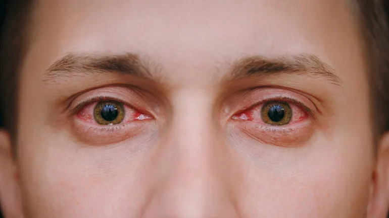 Κοκκίνισμα ματιών: 5 κοινές αιτίες και πώς θα το προλάβουμε