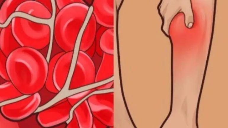 Προσοχή: 6 σημάδια που δείχνουν ότι ίσως έχετε θρόμβους στο αίμα