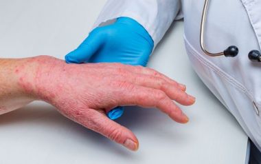 Κορωνοϊός: Το «Covid toe» και άλλα τέσσερα εξανθήματα που προβληματίζουν τους γιατρούς