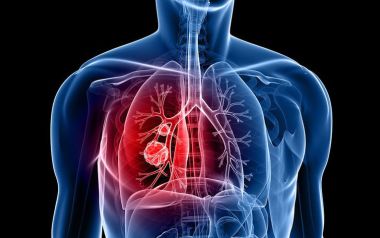 Καρκίνος του πνεύμονα: Θεραπεία πρώτης γραμμής αλλάζει το τοπίο στην αντιμετώπισή του