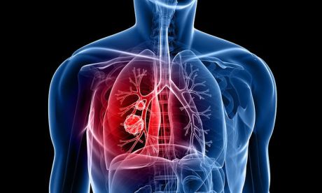 Καρκίνος του πνεύμονα: Θεραπεία πρώτης γραμμής αλλάζει το τοπίο στην αντιμετώπισή του
